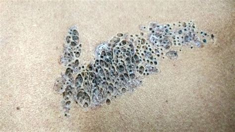 50 Minutes of Blackheads! Clusters of Blackheads with Dr..